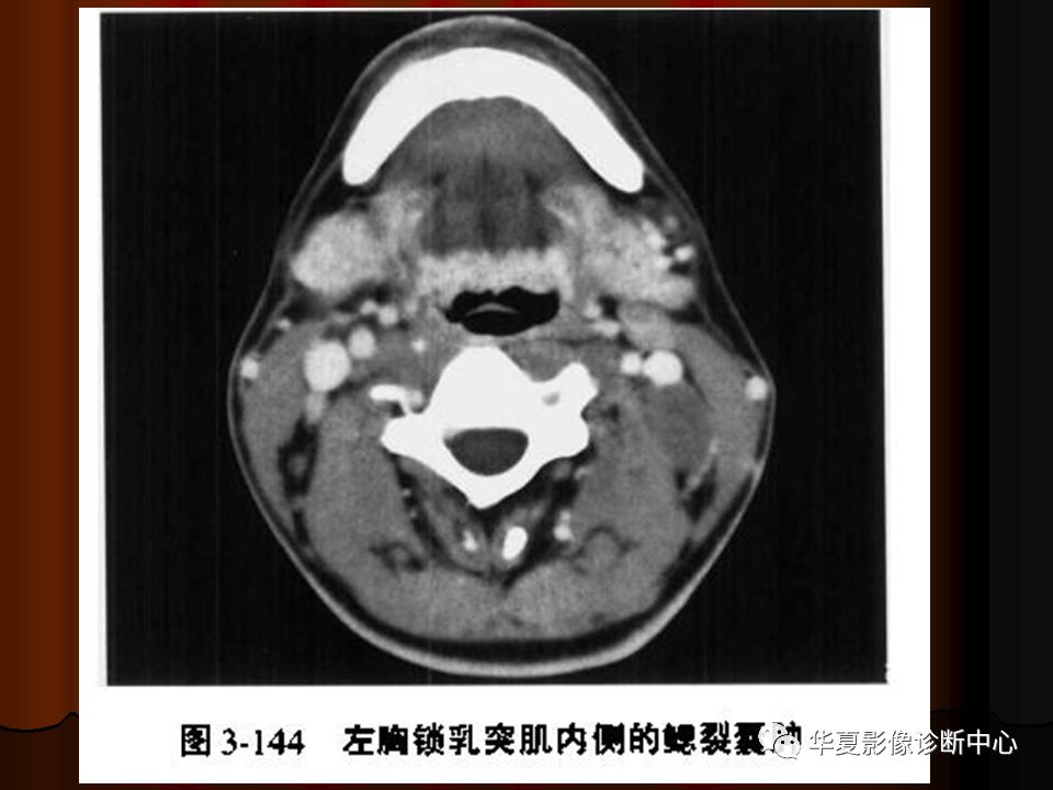 口腔颌面部ct诊断