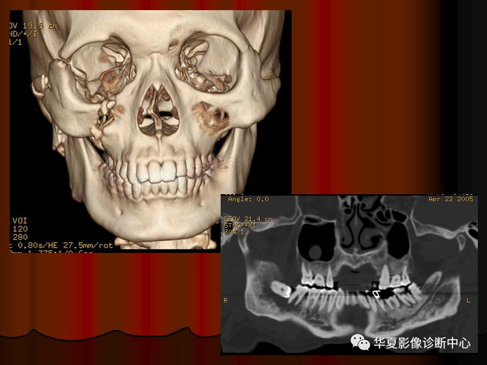 口腔颌面部ct诊断