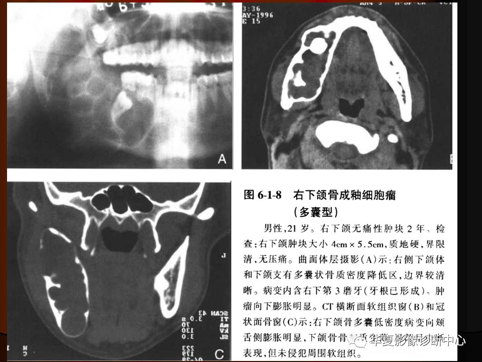 口腔颌面部ct诊断