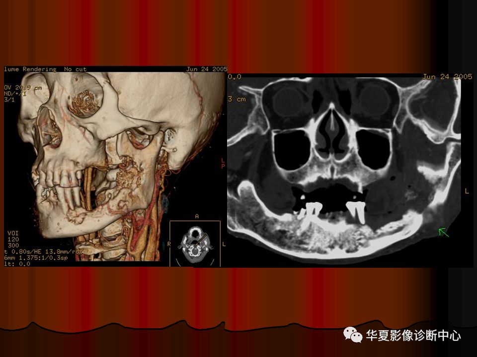 口腔颌面部ct诊断