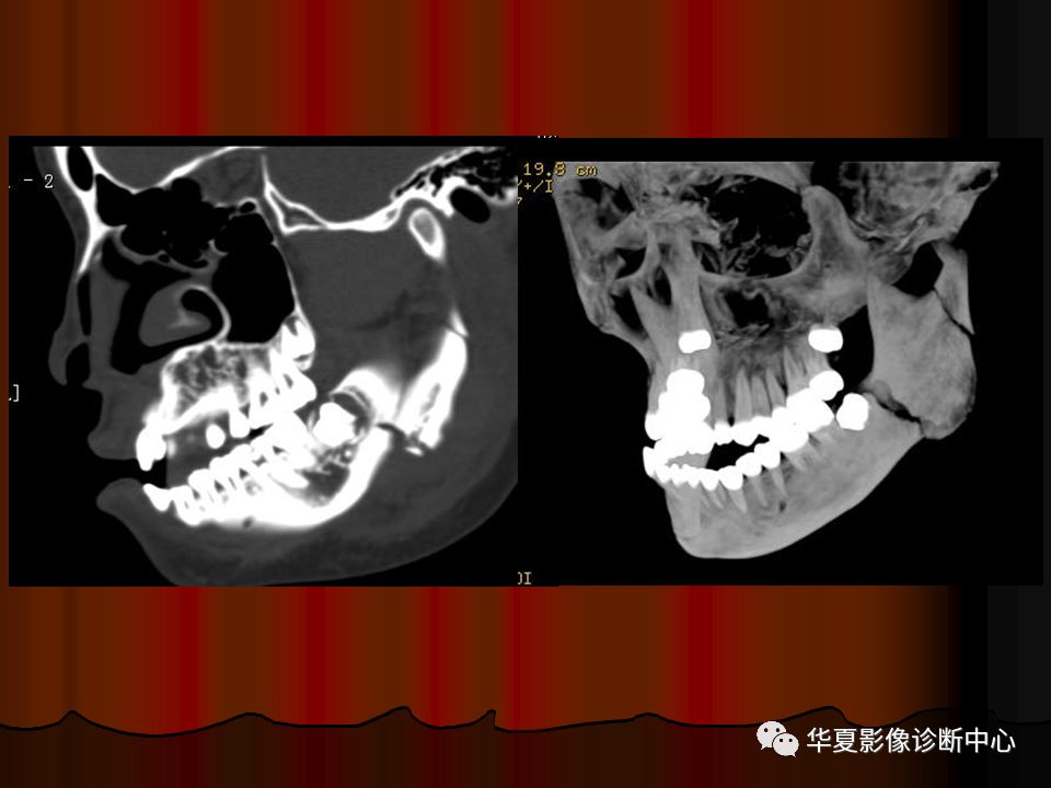 口腔颌面部ct诊断