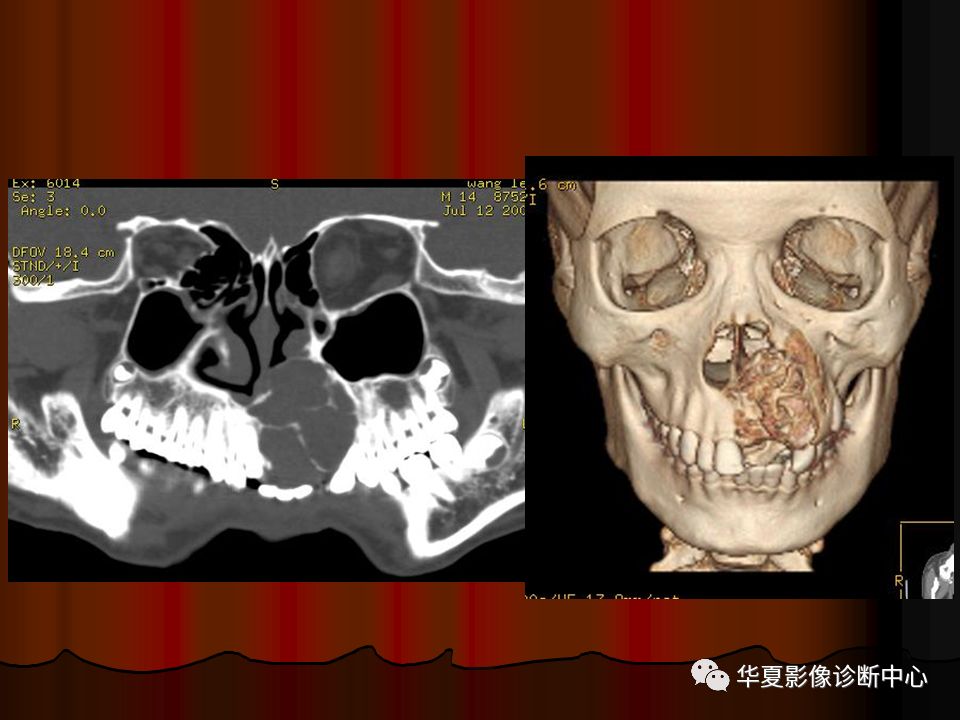 口腔颌面部ct诊断