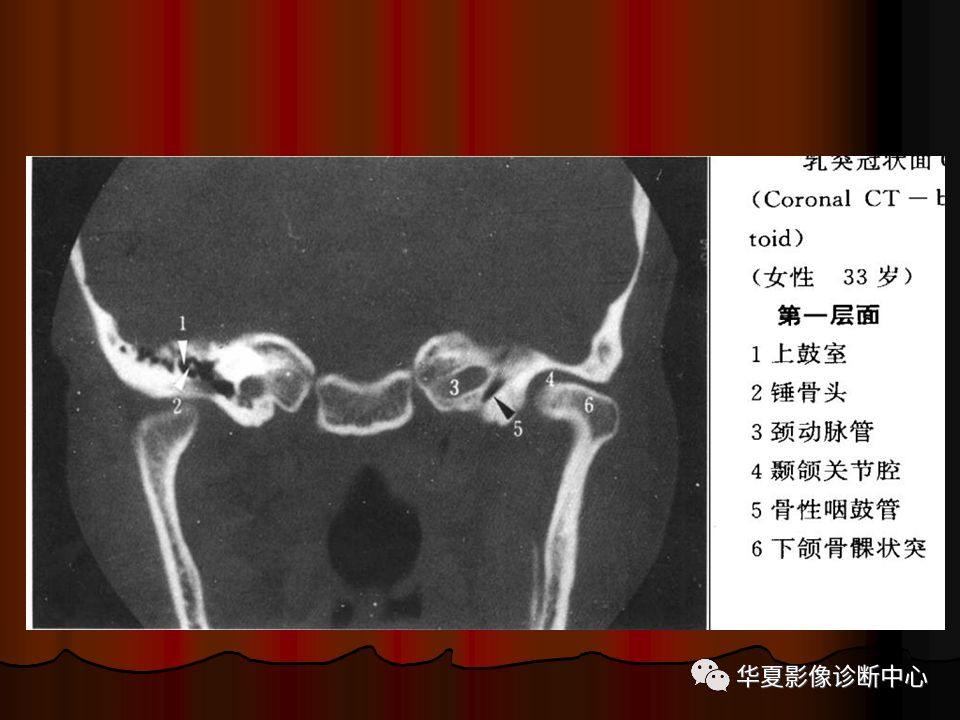 上下颌骨ct平扫解剖图片