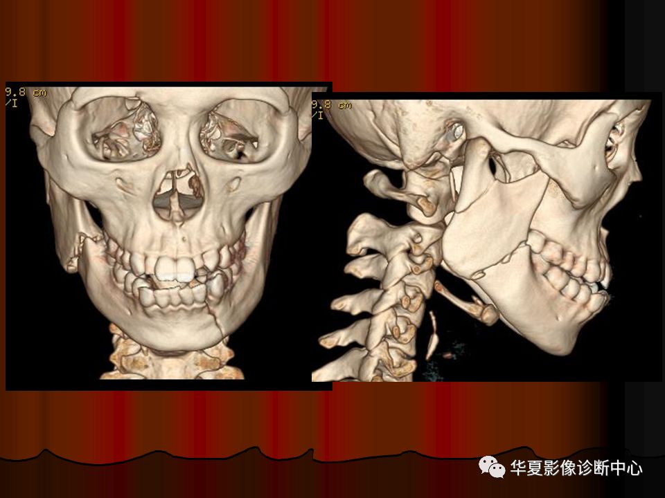 口腔颌面部ct诊断