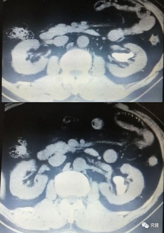 泌尿系超聲:左腎內可見多個強回聲斑較大的約3.9x1.