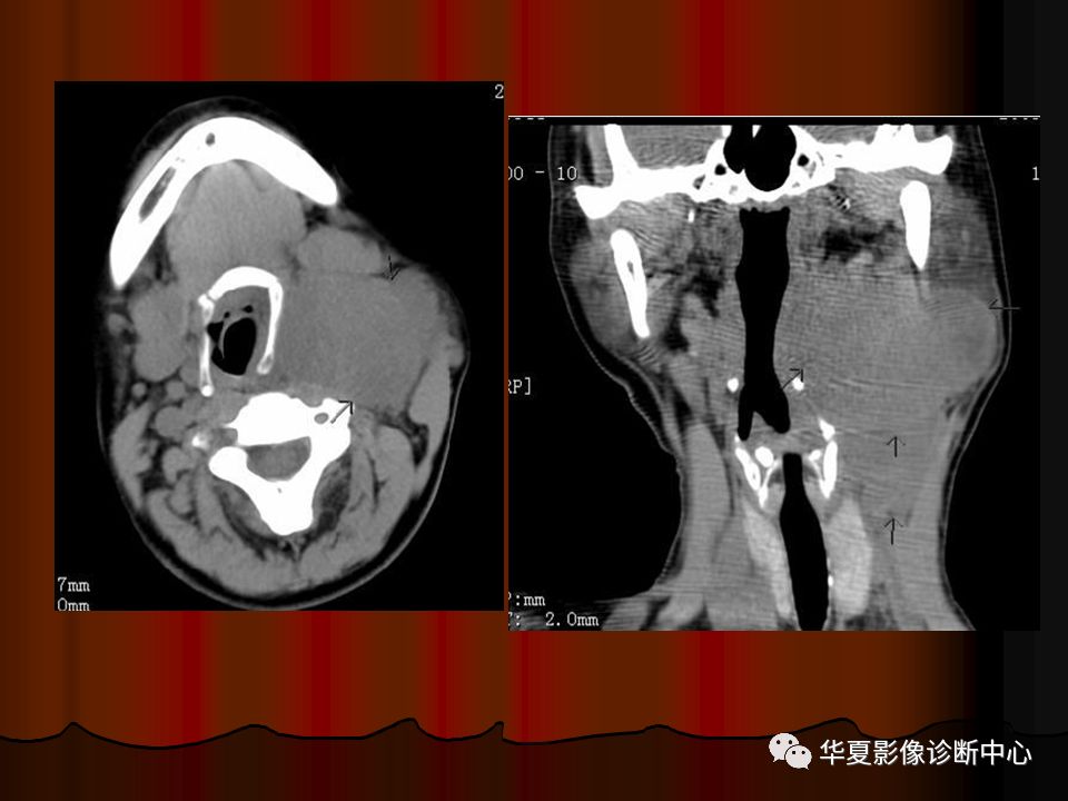 口腔颌面部ct诊断