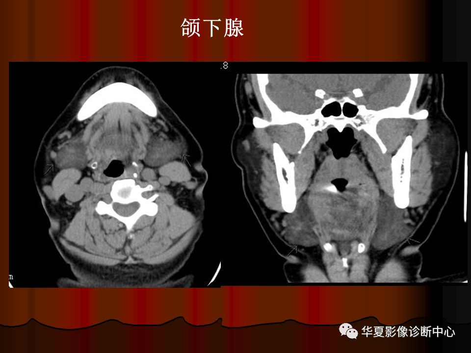 口腔颌面部ct诊断