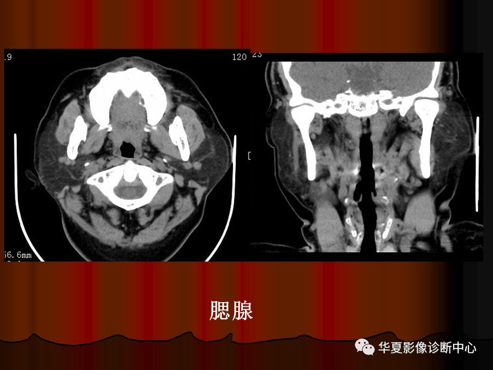 口腔颌面部ct诊断