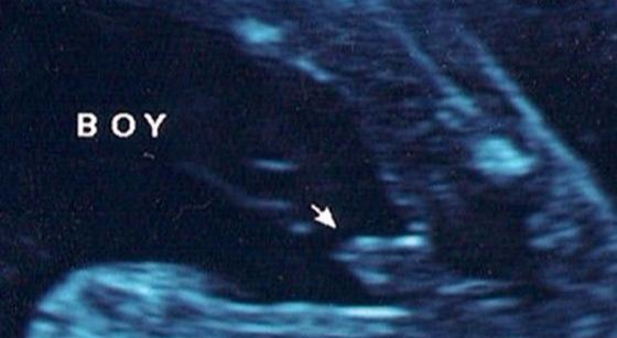 孕25周胎儿小鸡彩超图图片