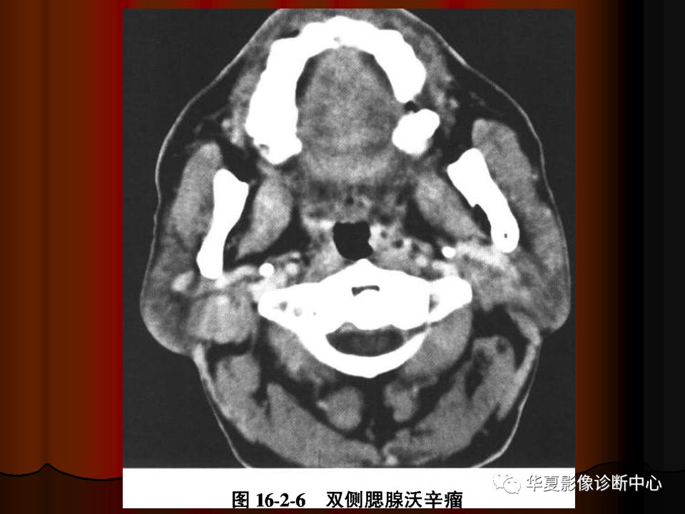 口腔颌面部ct诊断