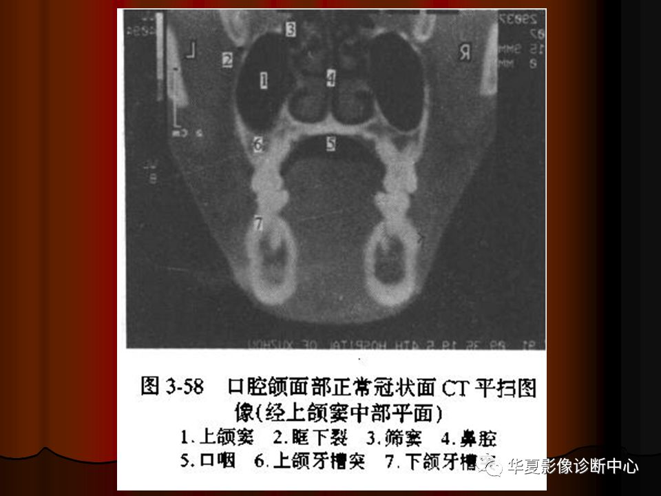 口腔颌面部ct诊断