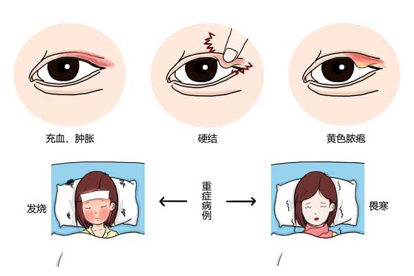 如何判断是不是针眼-搜狐大视野-搜狐新闻