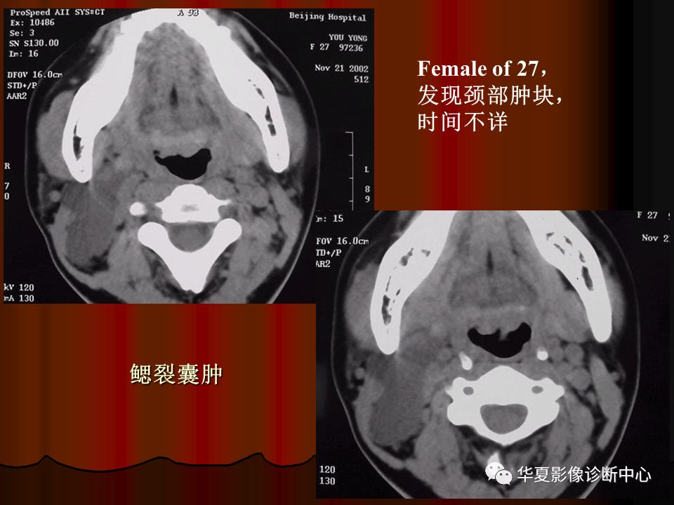 口腔颌面部ct诊断