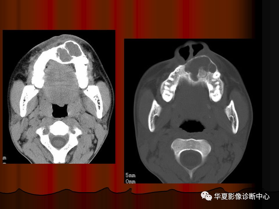 口腔颌面部ct诊断