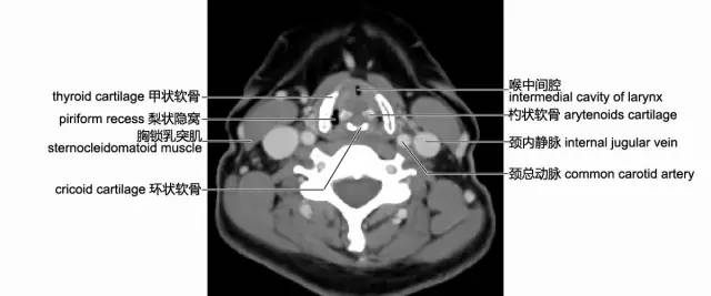颈部软组织CT解剖图片