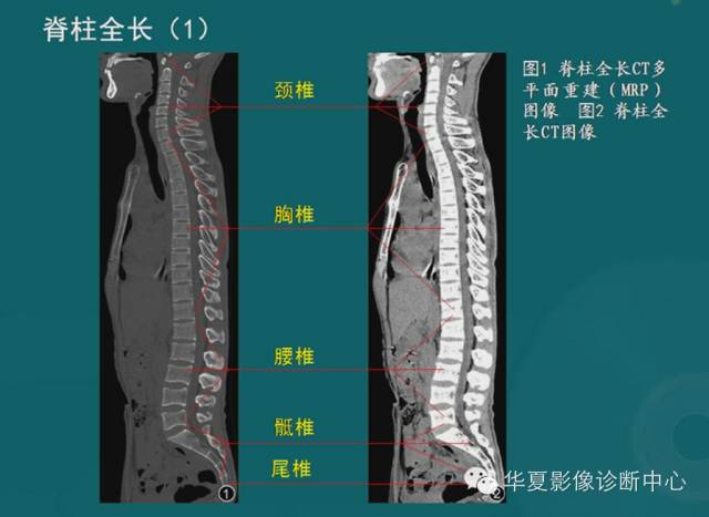 脊柱检查之x线ctmri影像解剖