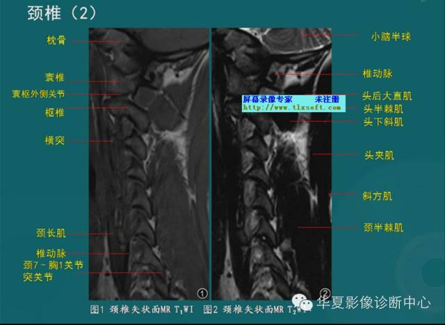 脊柱檢查之x線ctmri影像解剖