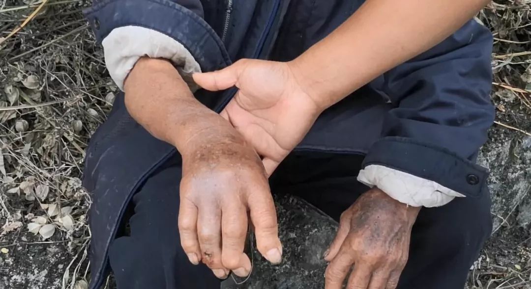 经询问驾驶人得知,他们驾车准备前往水口医院,送被毒蛇咬到手的爷爷