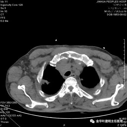 經驗積累增強ct上這些斑斑點點啥