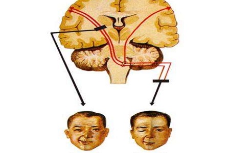 核上瘫和核下瘫区别图片