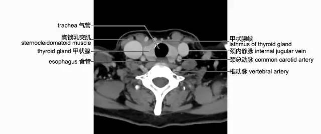 喉返神经CT图片