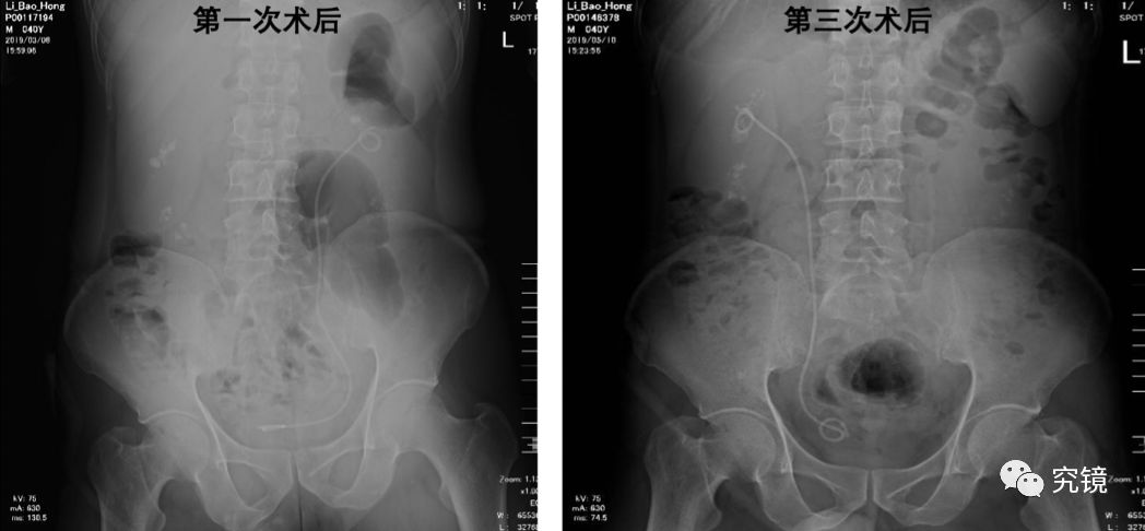 输尿管结石平片图片