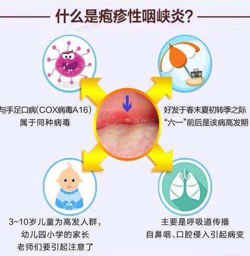 疱疹性咽峡炎挂什么科图片