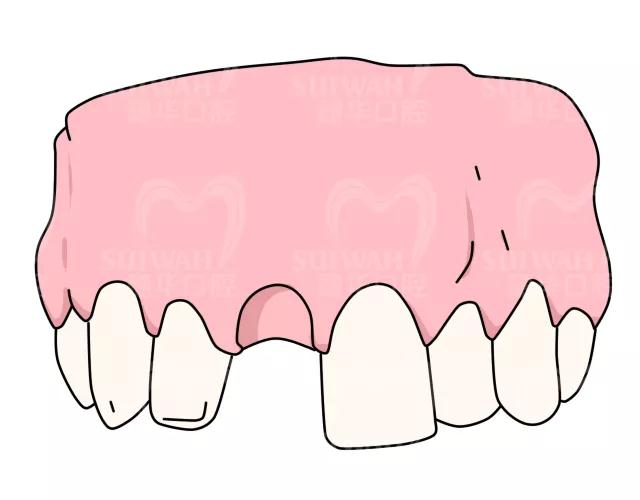 拔牙后最佳的镶牙时间是多久