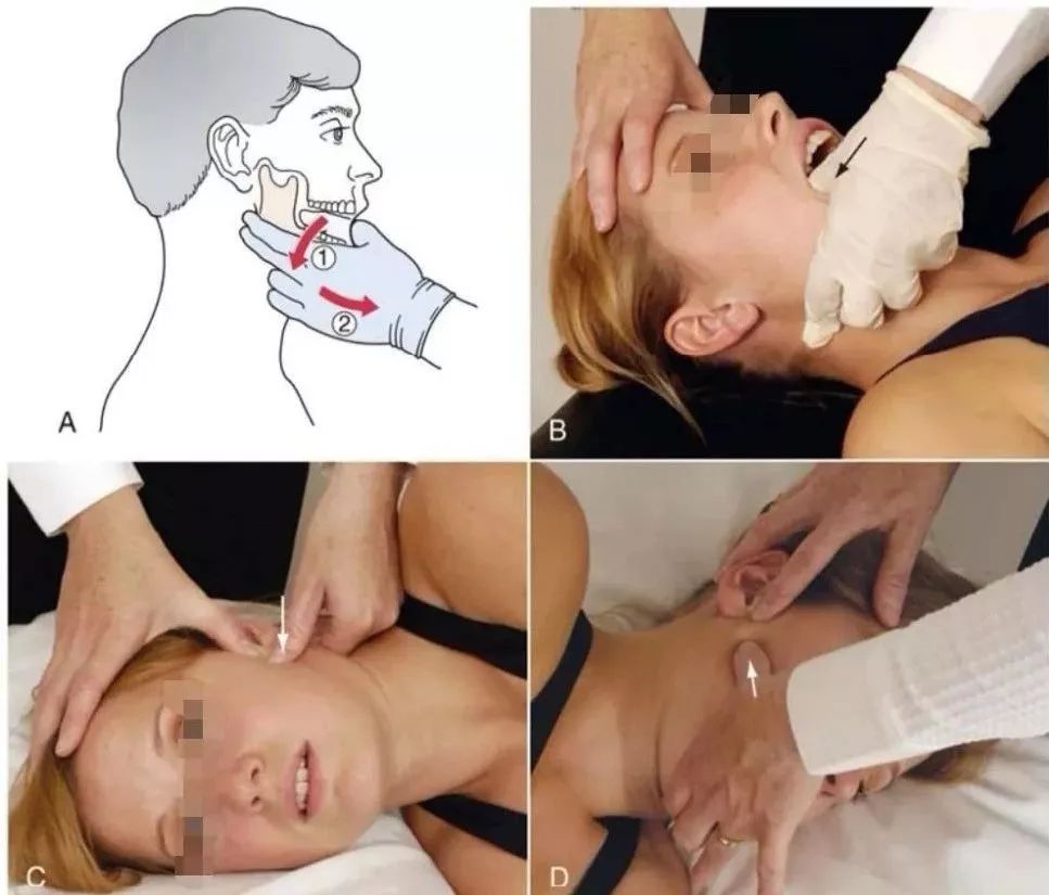 颞下颌关节紊乱患者常见有咬肌等咀嚼肌群,舌骨肌群,枕后肌群以夹胸