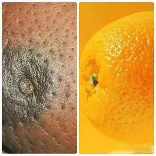 当你发现乳头乳晕越来越黑的时候,当你发现乳头內陷的时候,当你发现