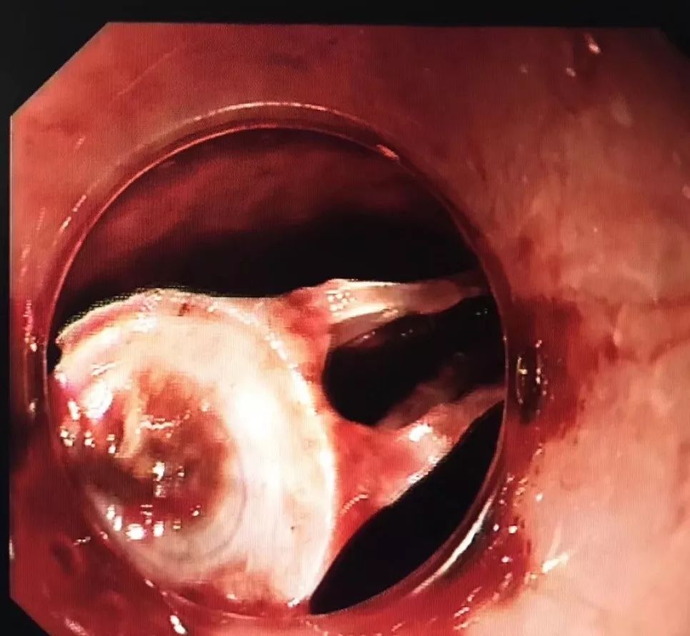 男子不慎鱼刺卡喉咙!医生:赶紧把手套吃下去!结果.