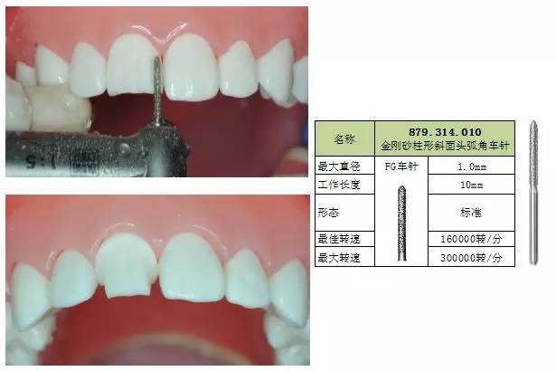 高难度畸形扭转牙的瓷贴面预备