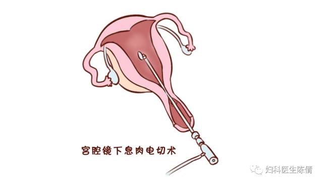 宫颈息肉卡通图片图片