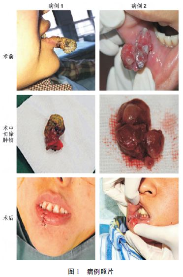 妊娠期下唇分叶状毛细血管瘤2例及文献复习