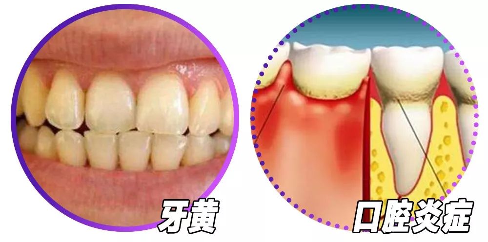 而更可怕的是,一般來說,牙黃,口腔炎症,蛀牙等問題,都是 和口臭問題