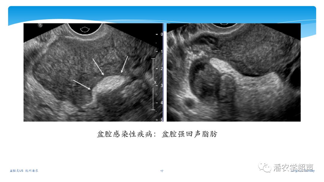 超声微课堂盆腔炎超声诊断