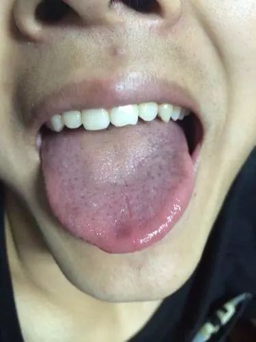 ③开始时舌苔偏腻,嘴巴里有些不干净,腻腻的感觉,最后舌头颜色偏暗,偏