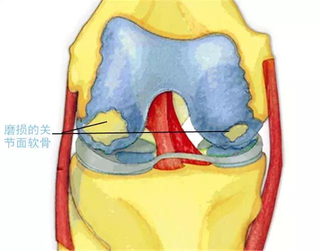 膝关节的构造和全膝关节置换手术