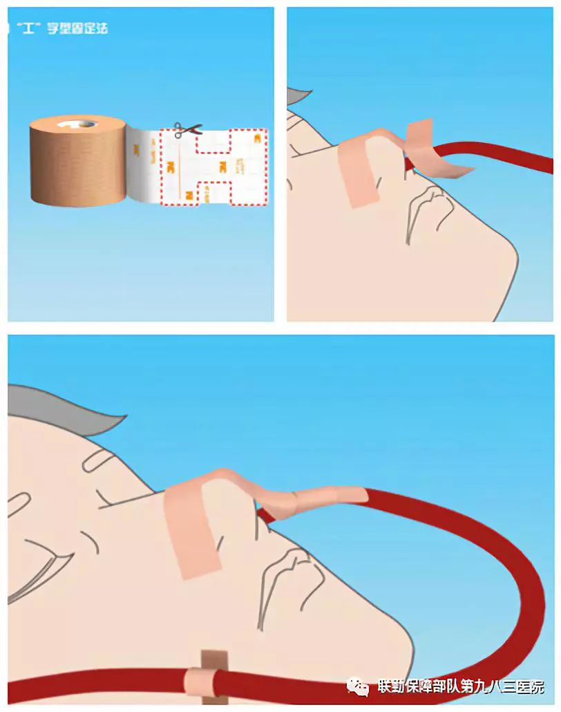 胃管绳子固定方法图片图片