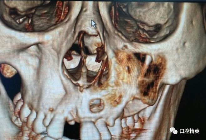 上颌窦囊肿的症状图片图片