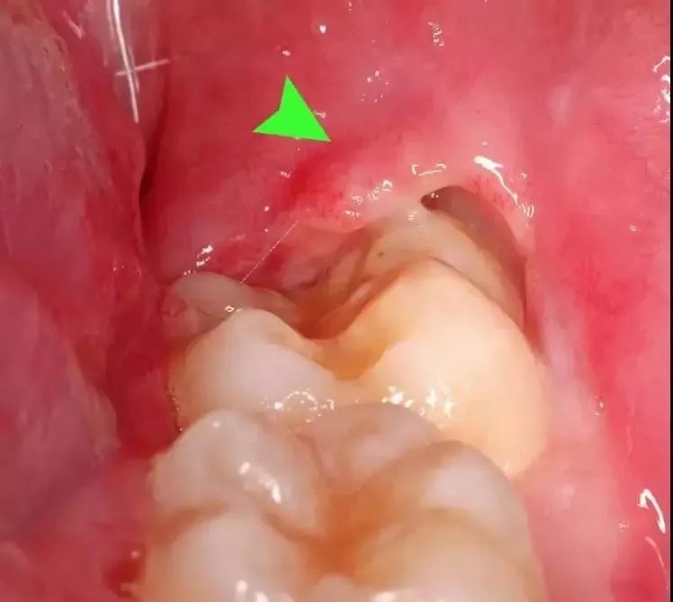 拔完智齿秒变松鼠脸肿成特效智齿到底该不该拔