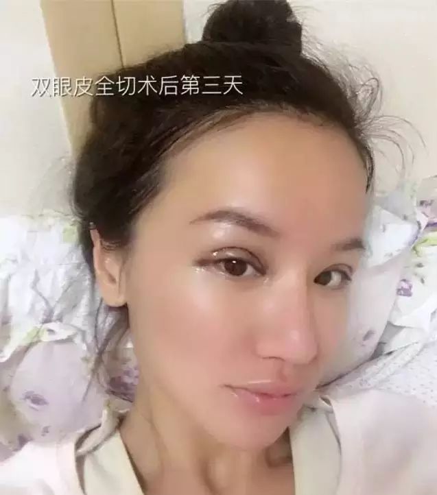 第三次整容缩了鼻翼,脸部的肌肉松弛埋线提升,嘟嘟唇,隆胸▼这个时候