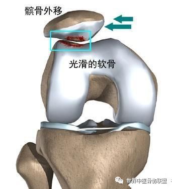 膝盖打软腿可能是髌骨软化症是卧床还是锻炼