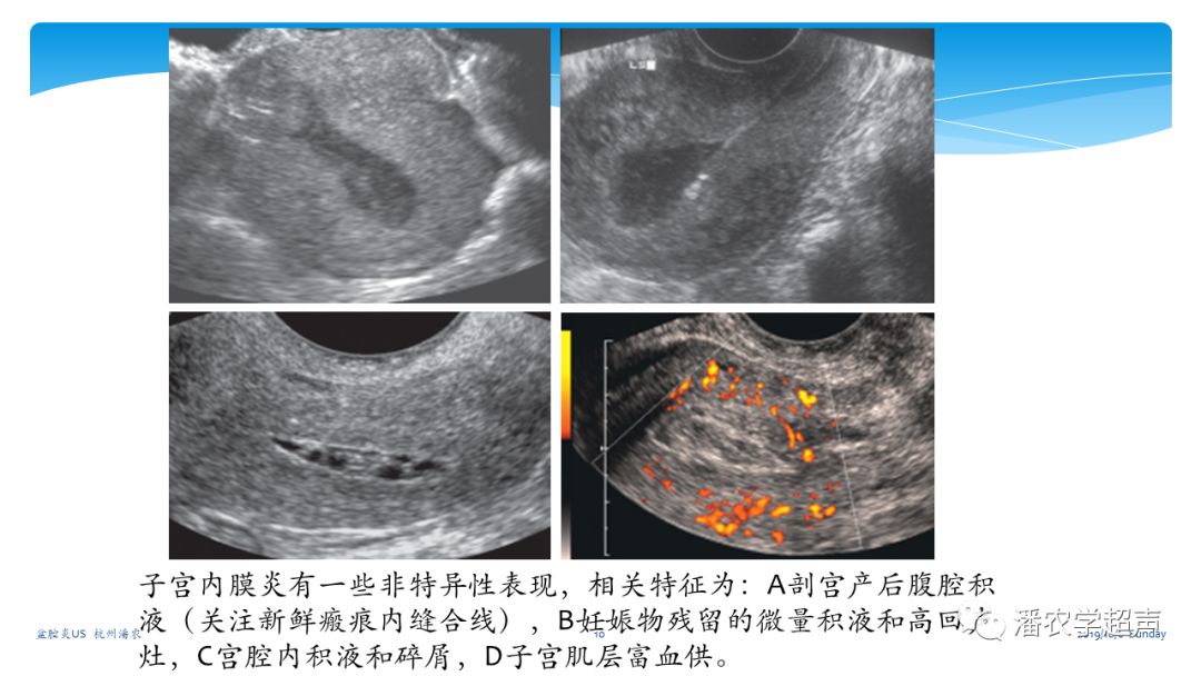 超声微课堂盆腔炎超声诊断