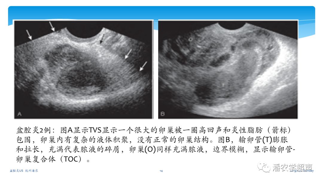 超声微课堂盆腔炎超声诊断