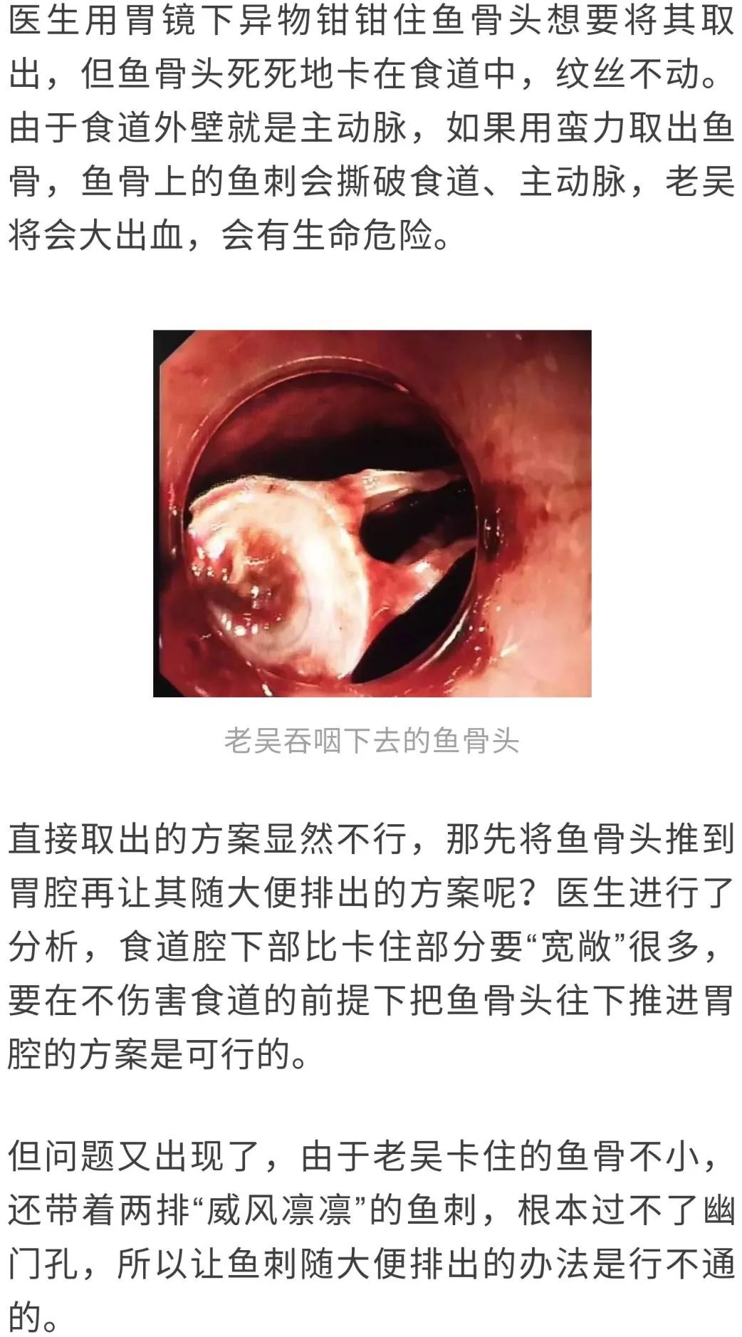 带刺鱼骨卡男子食道 医生 赶紧把手术手套吃下去 结果