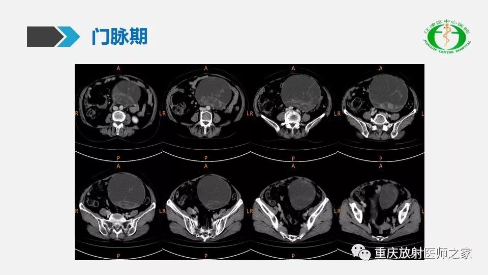 每日一例95667岁女盆腔包块半年ct平扫增强后什么结果