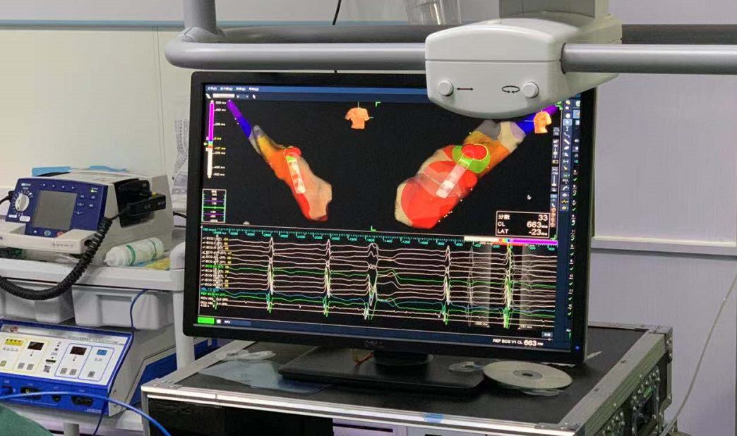 新技术我市首例三维标测下射频消融术让心律失常患者重获心生