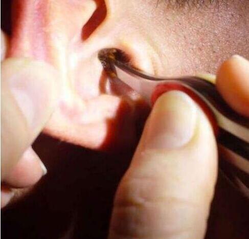 耳屎在耳朵的位置图图片