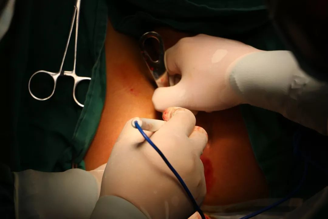 肛瘘袋形缝合手术图片图片